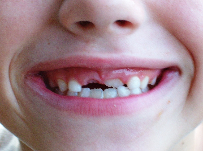Dientes molares