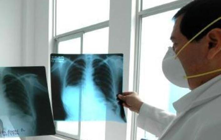 salud tuberculosis